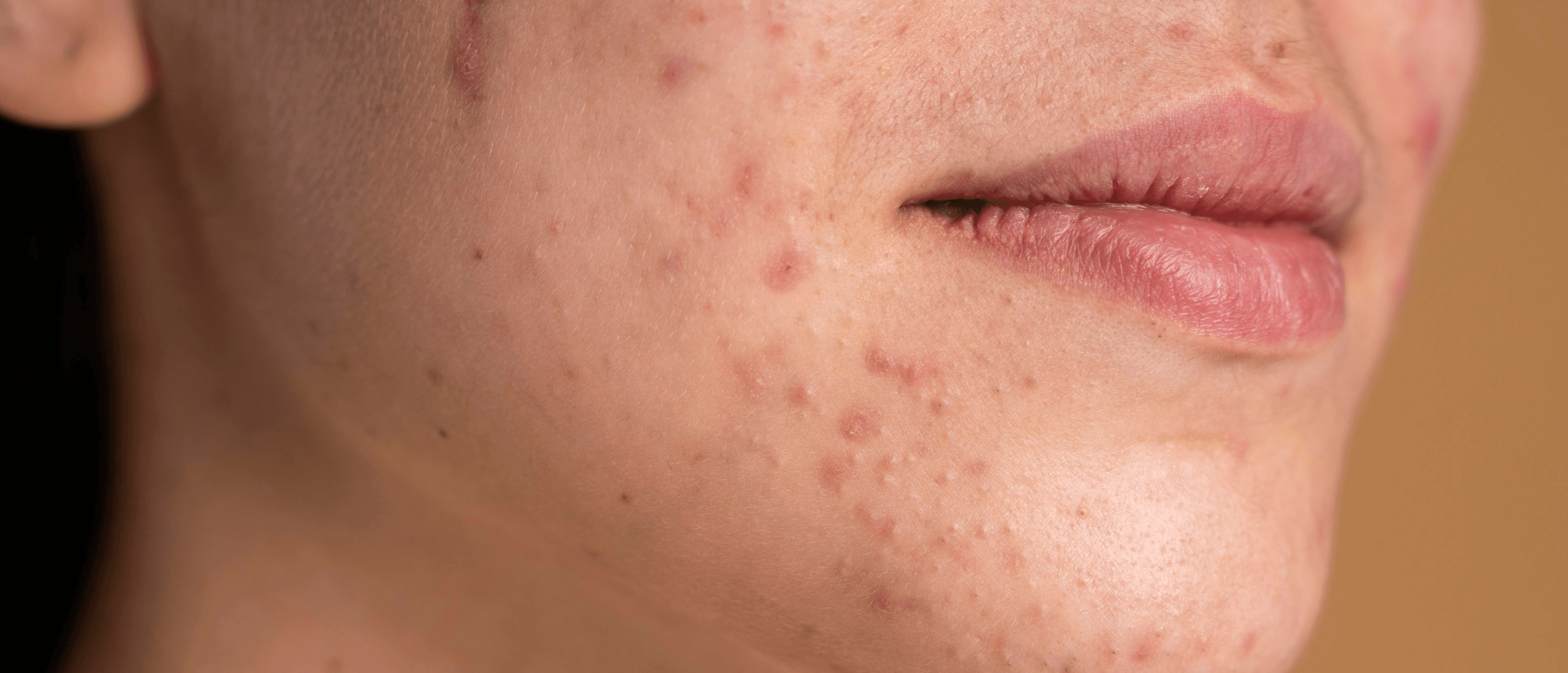 Free (bioavailable) Testosterone